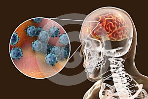 Viral encephalitis, medical concept