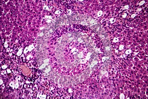 Viral hepatitis, light micrograph photo
