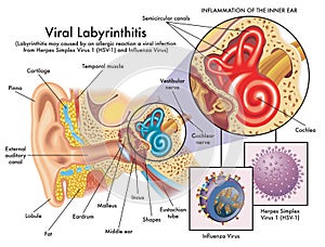 Viral labyrinthitis illustration