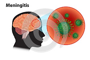 Viral meningitis and encephalitis photo