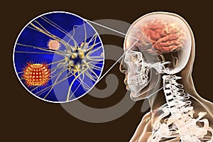 Viral meningitis and encephalitis, medical concept
