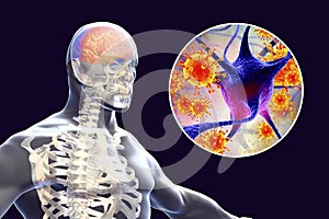 Viral meningitis and encephalitis, medical concept