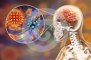 Viral meningitis and encephalitis, medical concept