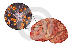 Viral meningitis and encephalitis, medical concept