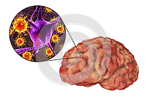 Viral meningitis and encephalitis, medical concept