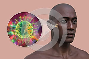 Viral otitis media ear infection, 3D illustration