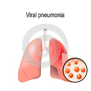 Viral pneumonia. Normal and inflammatory condition photo