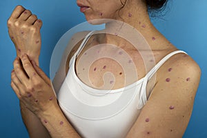 Viral rash on woman& x27;s body because of monkeypox disease photo