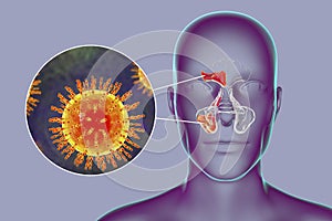 Viral sinusitis, inflammation of paranasal cavities and close-up view of viruses
