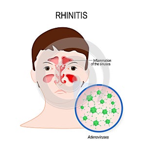 Viral sinusitis Rhinitis caused by adenovirus