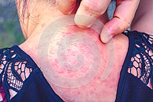 Viral skin disease Measles rash women with dermatitis of Itching of the blister on Occipital.