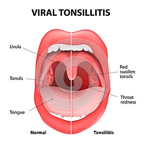 Viral tonsillitis photo