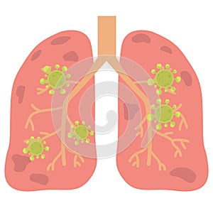 Virus or bacterial infects lungs.virus invades lungs