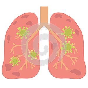 Virus or bacterial infects lungs.virus invades lungs photo