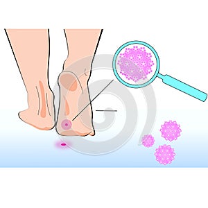 Virus on heel on a white background. Vector illustration