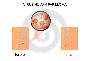 Virus human papilloma