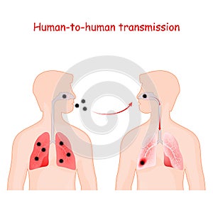 Virus. human-to-human transmission. contamination of virus. Coronavirus in lungs photo