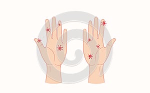 Virus on humans hands. Vector flat style illustration isolated on white background