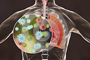 Viruses in human lungs photo