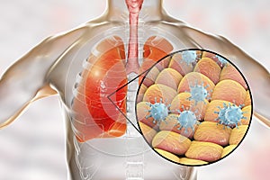 Viruses in human lungs photo