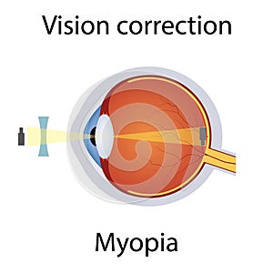 Vision Correction of Myopia Illustration. Eyesight Disorders. Eyes Defect Corrected by Concave Lens Concept. Detailed
