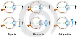 Visione miopia un astigmatismo 