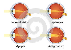 Vision disorders. Concept of eyes defect. Normal vision, hyperopia, myopia, astigmatism. Anatomy eyeball. Vector