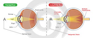 Vision of Normal eye and Astigmatic