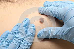 Visual examination of the mole for the presence of malignant neoplasms. Prevention for detecting skin cancer and melanoma
