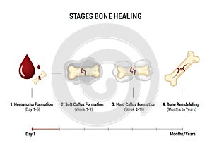 Visualizing bone fracture healing stages from hematoma to remodeling