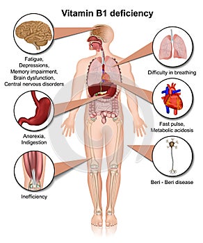 Vitamin B1 deficiency 3d medical vector illustration infographic on white background thiamine