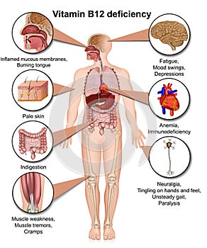 Vitamin B12 deficiency infographic, 3d medical vector illustration on white background