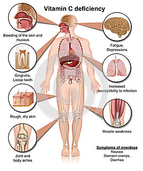 Vitamin C deficiency 3d medical  illustration on white background