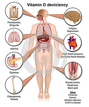 Vitamin D deviciency body effects medical  illustration on white background