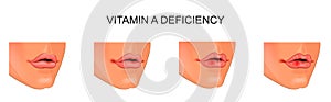 Vitamin Ð deficiency