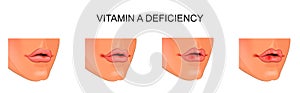 Vitamin ÃÂ deficiency