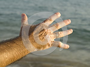 Vitiligo photo