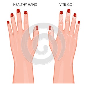 Vitiligo_Arm with colored nails