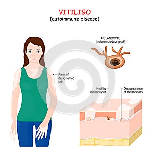 Vitiligo. autoimmune disease