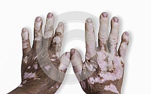 Vitiligo disease on old hand.