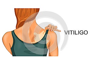 Vitiligo on female back photo