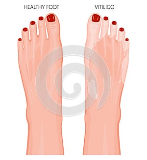 Vitiligo_Foot with colored nails