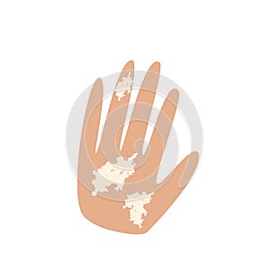 Vitiligo on the hand. White spots on the skin of the hand. Infographics vector illustration.
