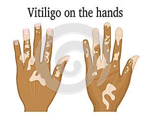 Vitiligo on the hands photo