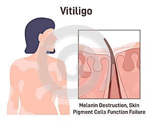 Vitiligo. Leucoderma skin anatomical structure. Long-term skin
