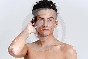 Vitiligo man portrait