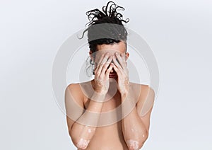 Vitiligo man portrait