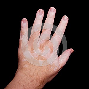 Vitiligo