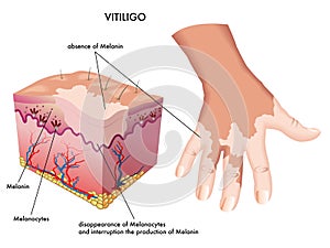 Vitiligo