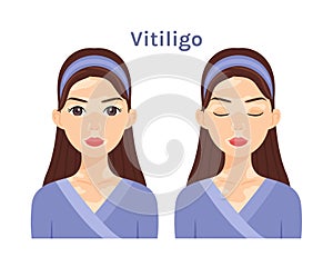 Vitiligo. Portrait of Isolated Beautiful Brunette woman. Cute face. Skin disease.Treatment. Depigmentation skin. Woman with open